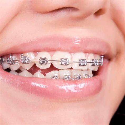 metal brackets en español|Ortodoncia con brackets metálicos: ventajas e .